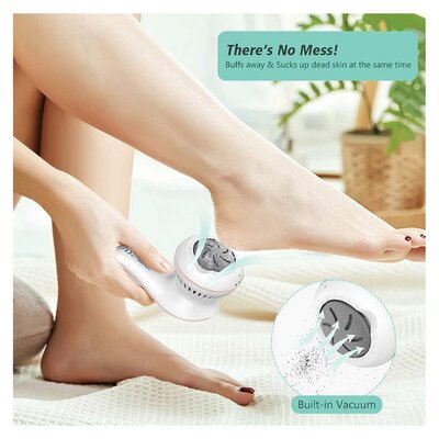 Igia Foot Callus Remover | Smart Price Specials | PnP Home